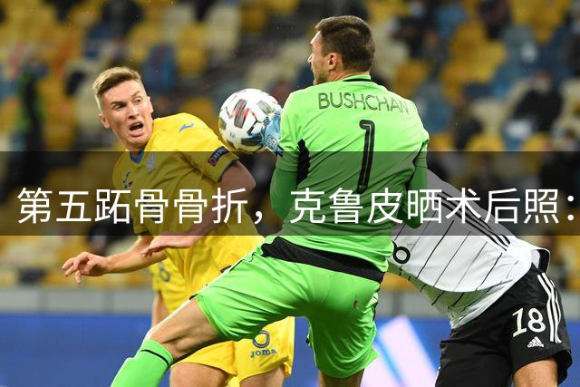 第五跖骨骨折，克鲁皮晒术后照：手术顺利完成